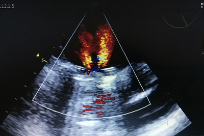 市四医院成功开展经食管超声心动图检查-四院动态-市