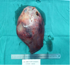 13岁女孩肝脏长了4斤重的肿瘤.