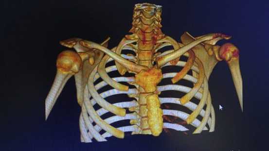 肩胛骨三维重建图片图片